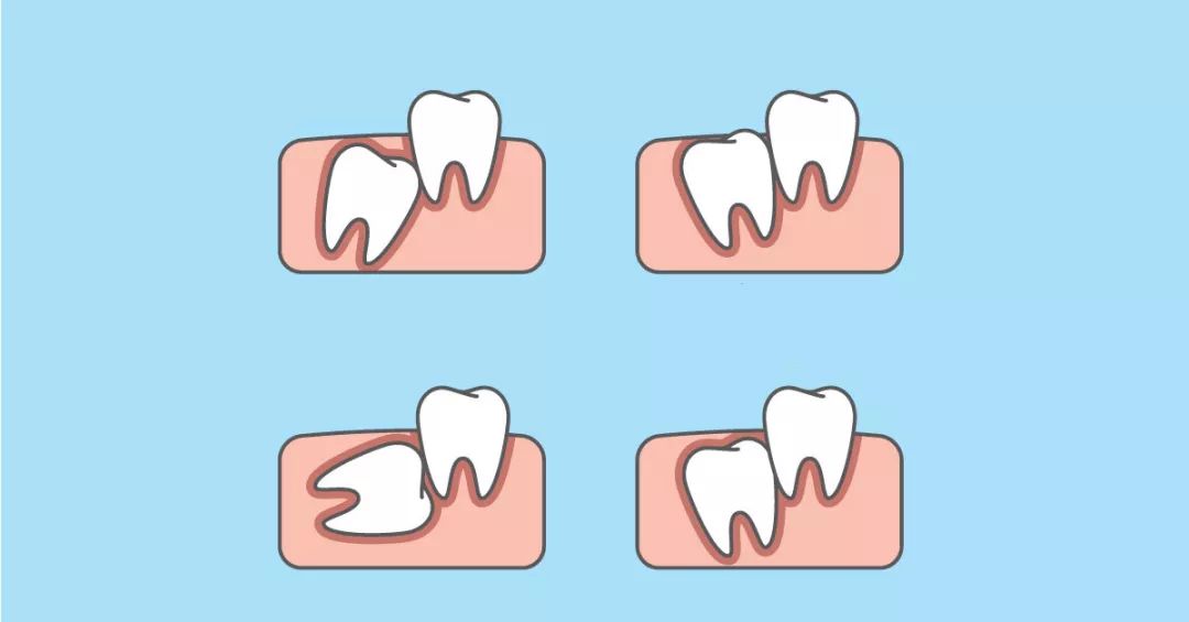 你需要了解关于智齿的这七个问题,智齿只剩牙根拔智齿的全过程