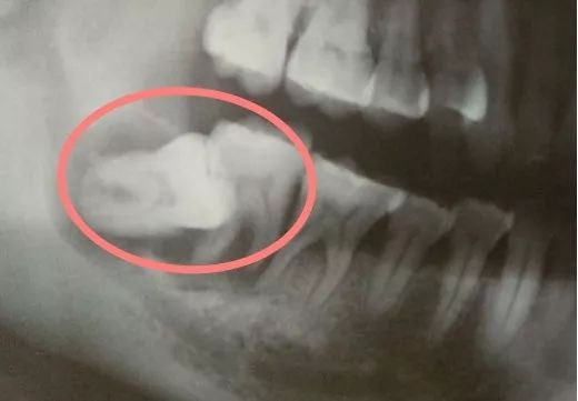 你需要了解关于智齿的这七个问题,智齿只剩牙根拔智齿的全过程