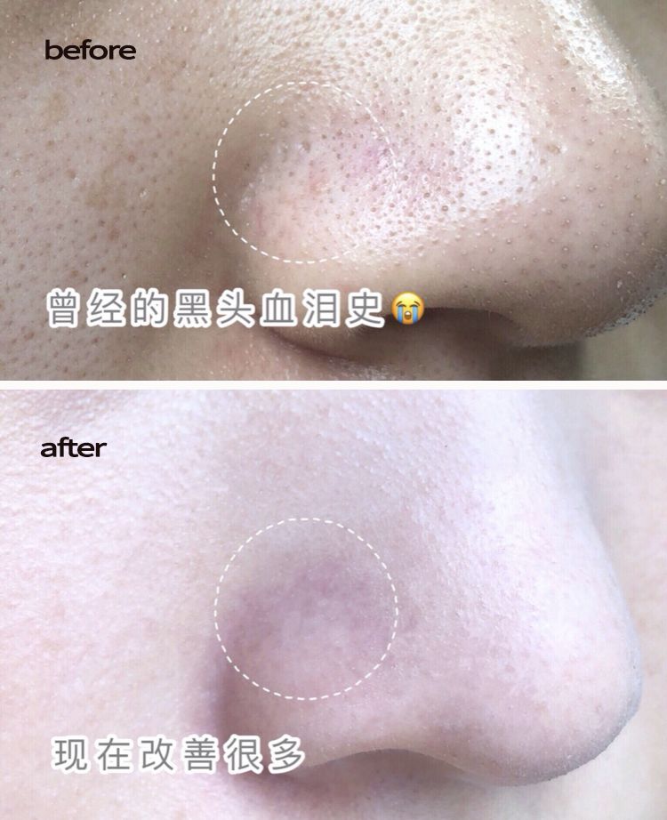 脸上搓出3斤泥！难怪又黄又暗又黑头！10秒给脸蛋“剥壳”，厉害