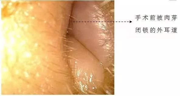 20多岁姑娘耳屎总也掏不尽，结果在耳朵里发现了这东西...