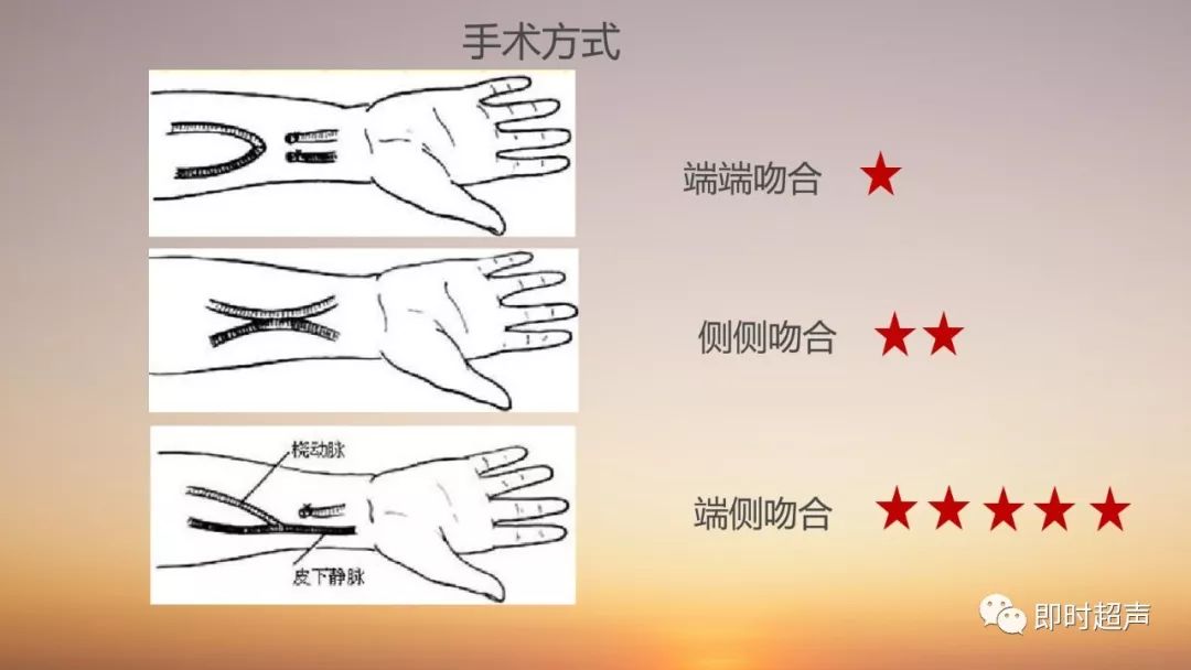 血液透析动静脉造瘘的超声评价
