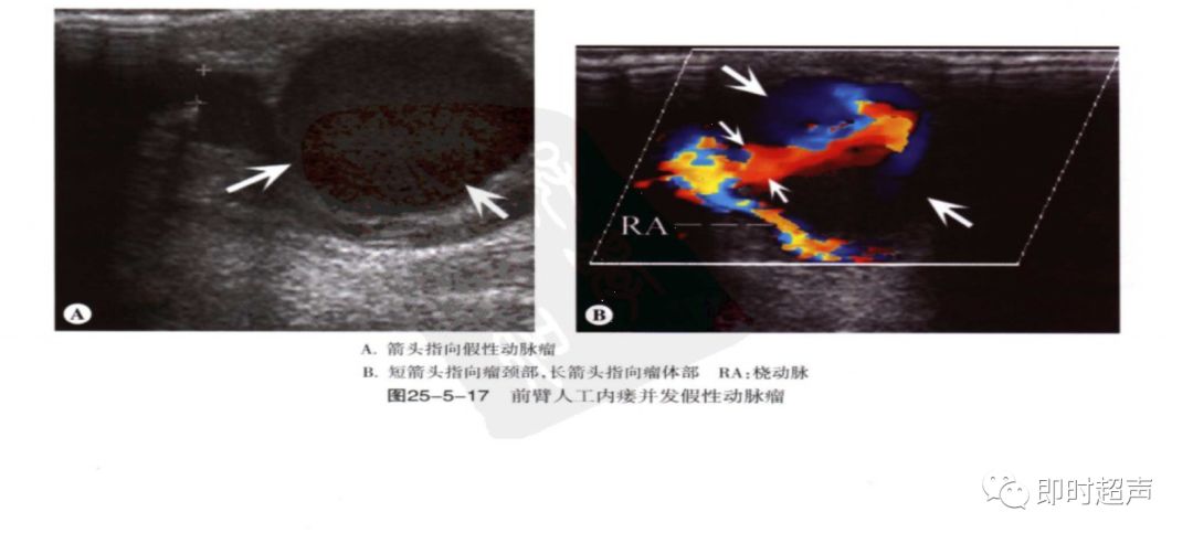 血液透析动静脉造瘘的超声评价