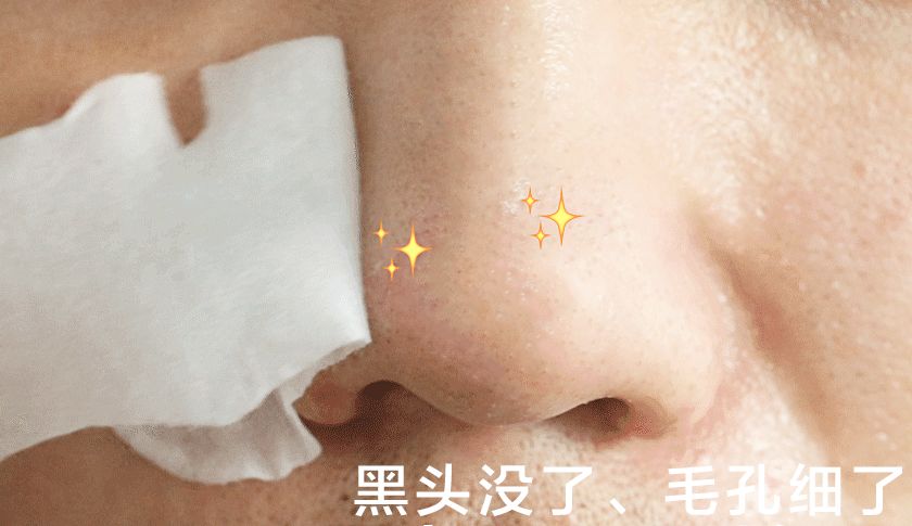 严重的黑头怎么处理教程,反复黑头的原因和解决方法