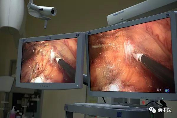 腹腔镜微创手术3d显示技术,3d腹腔镜和超高清腹腔镜