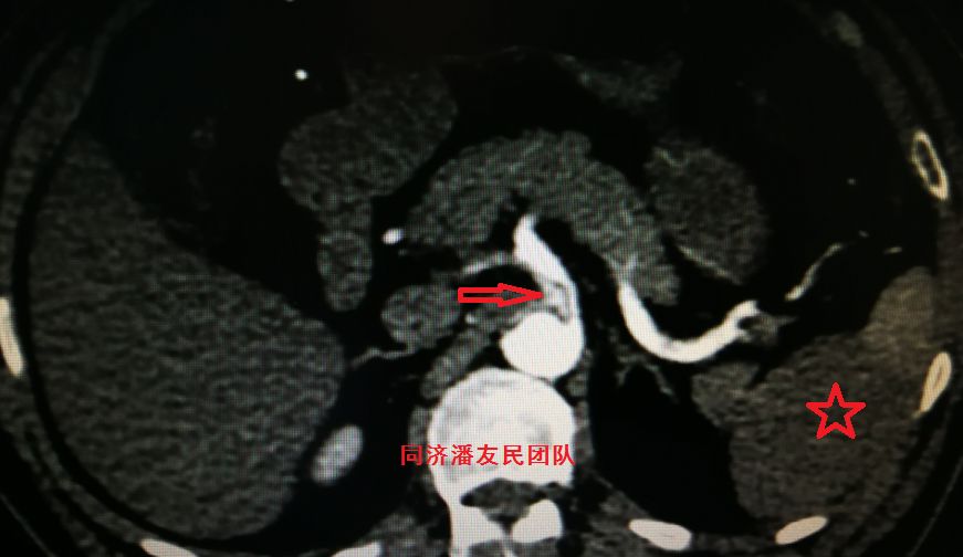 诊断主动脉夹层最简单有效的方法,心脏主动脉夹层是什么原因导致的