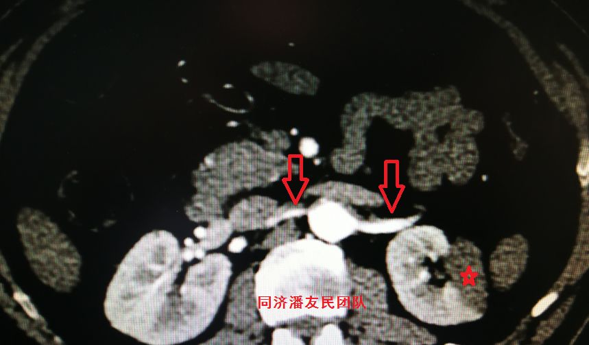 诊断主动脉夹层最简单有效的方法,心脏主动脉夹层是什么原因导致的
