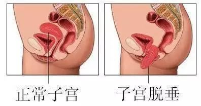 大笑就会尿失禁,盆底松弛尿失禁怎么治疗