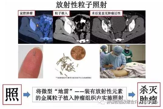 咯血介入治疗后还要止血药吗,肺部大咯血的介入栓塞治疗