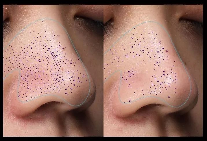 严重的黑头怎么处理教程,反复黑头的原因和解决方法