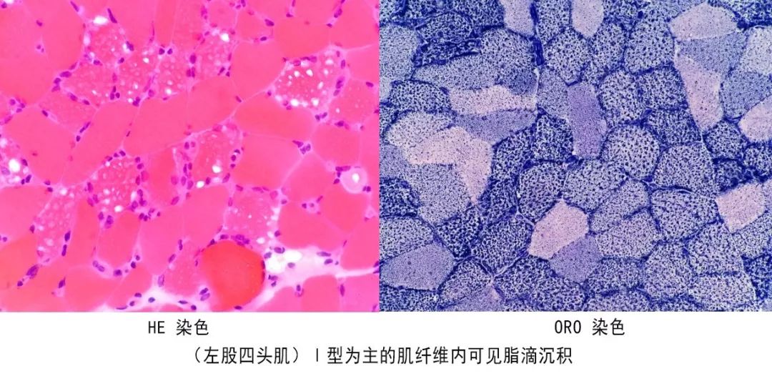 我国最常见的脂质沉积性肌病,一组数据带你了解罕见病