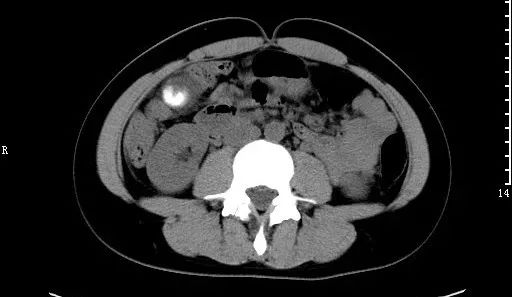 急诊科常见急腹症观察,腹部急诊影像大全值得收藏