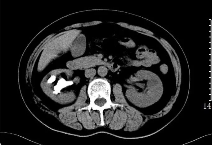 急诊科常见急腹症观察,腹部急诊影像大全值得收藏