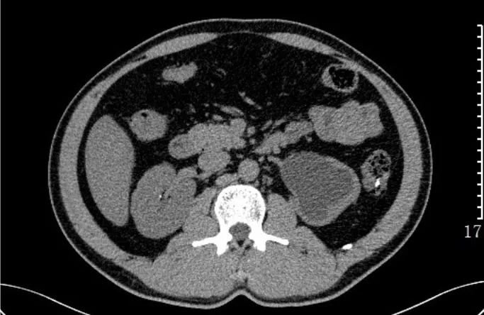 急诊科常见急腹症观察,腹部急诊影像大全值得收藏