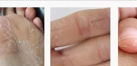 治脚气的抗真菌偏方,角化型脚气干裂最好的药