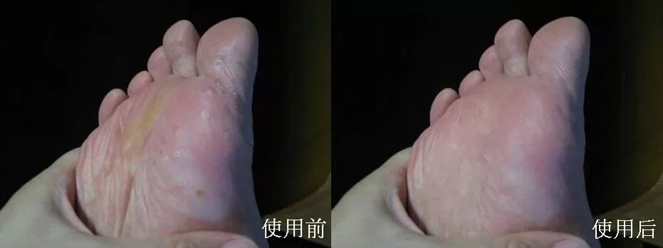 治脚气的抗真菌偏方,角化型脚气干裂最好的药