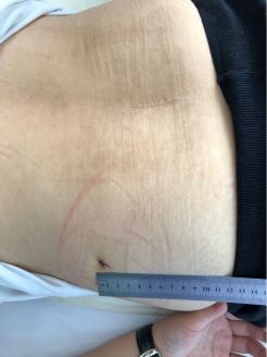 治“腰突”不想“开大刀”？看脊柱外科医生来支招