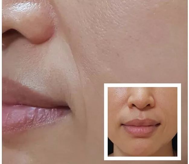 35岁了法令纹鱼尾纹眉间纹怎么办,三十岁就有眉间纹法令纹怎么办