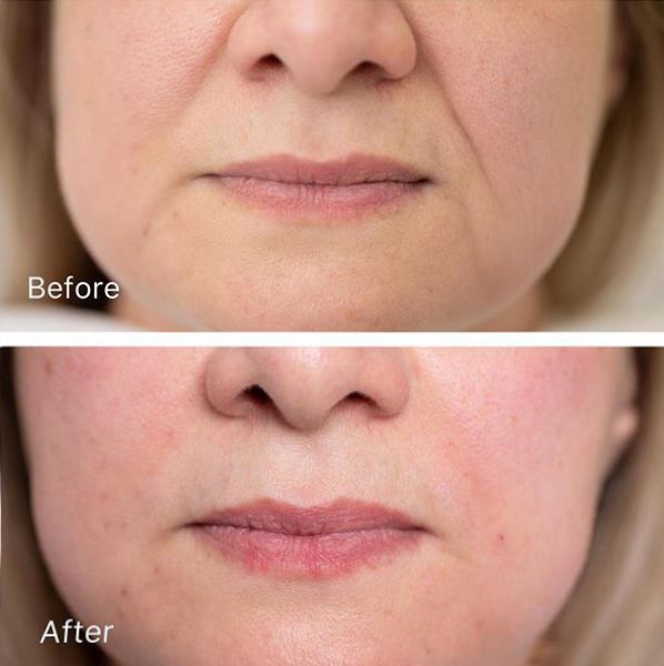 35岁了法令纹鱼尾纹眉间纹怎么办,三十岁就有眉间纹法令纹怎么办