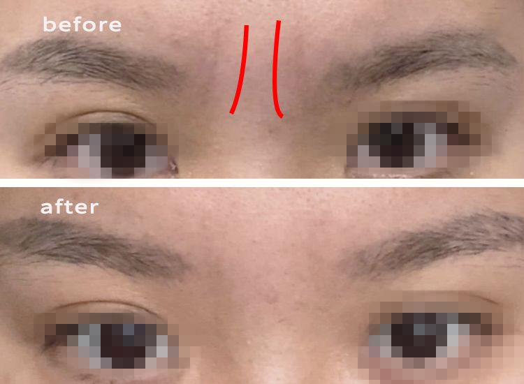 35岁了法令纹鱼尾纹眉间纹怎么办,三十岁就有眉间纹法令纹怎么办