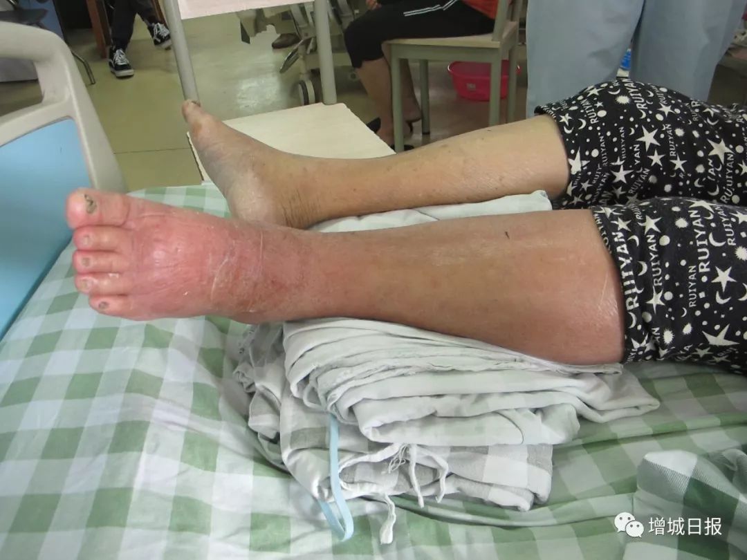 被红火蚁咬会休克或者死亡吗,被红火蚁咬后会有什么并发症吗