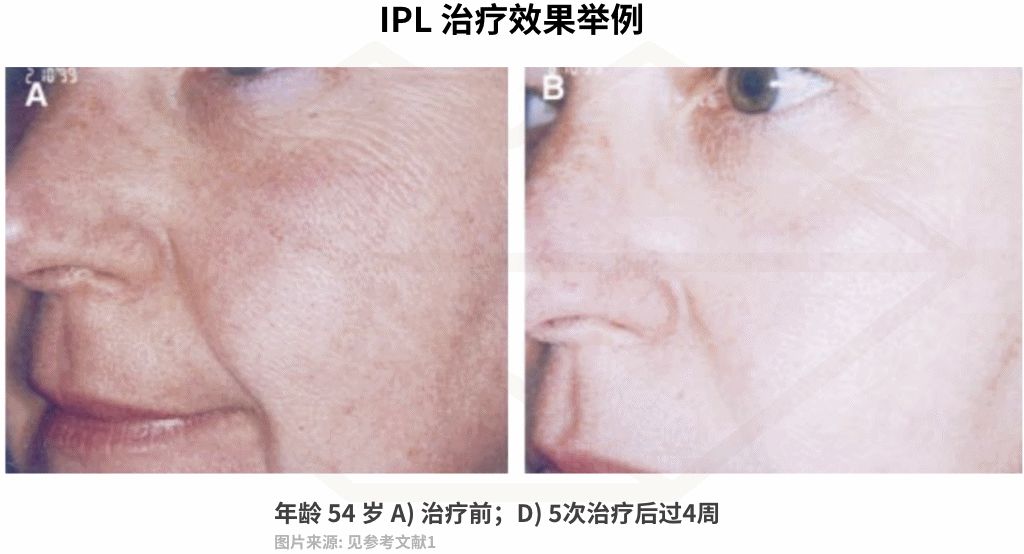 十几年的痘坑毛孔粗大,毛孔粗大不可逆别慌还有救