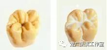 牙医讲解换牙小知识,孩子换牙期家长要注意的4件事