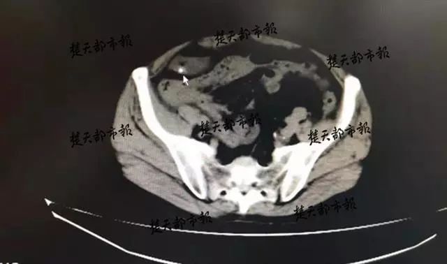 男子生吞一条活泥鳅险丢命,男子吃活泥鳅死亡