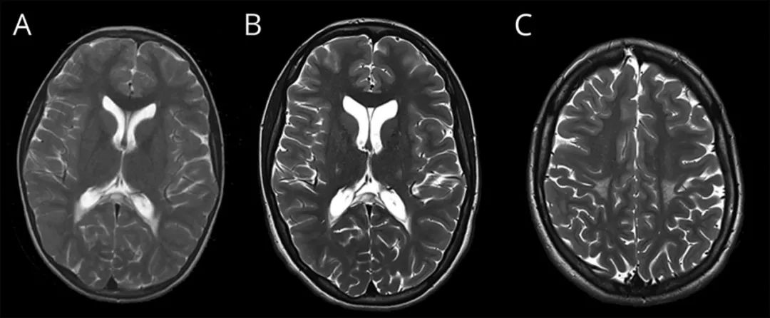 高足弓＋周围神经病，还要考虑这个病丨临床推理