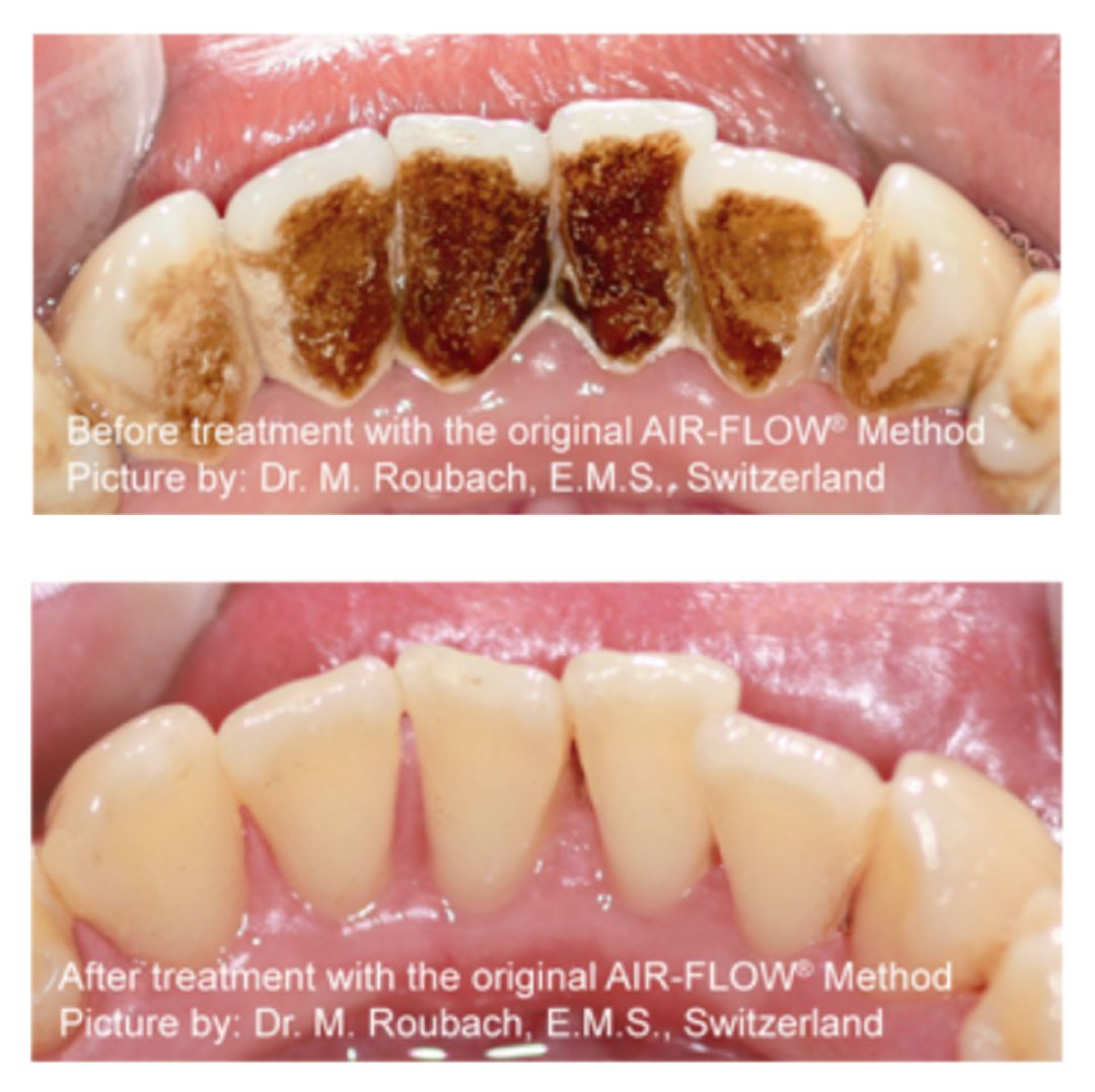 特别爱长牙石是怎么回事,长牙石是什么原因引起的