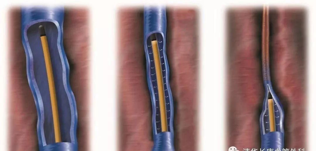 静脉曲张怎么保护好腿,夏季静脉曲张护腿