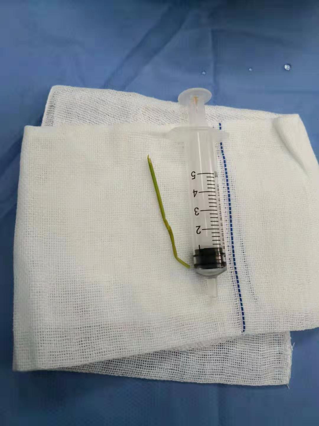 膀胱异物取出手术,哈尔滨看儿童泌尿科