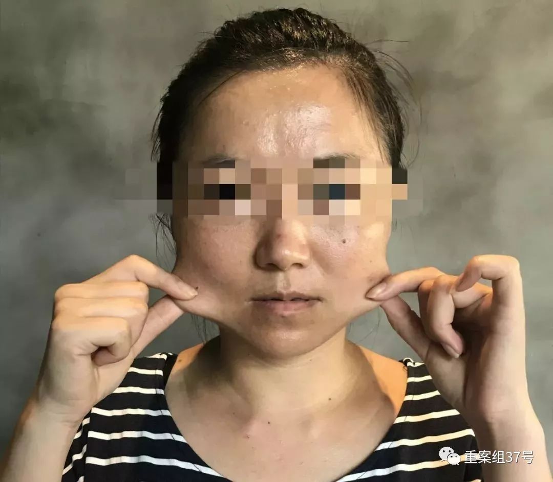 打瘦脸针毁容索赔300万,打瘦脸针毁容的案例