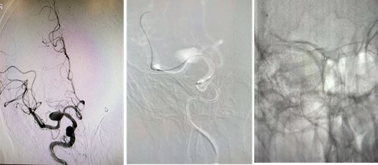 pipeline治动脉瘤,密网支架治疗动脉瘤原理