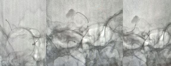 pipeline治动脉瘤,密网支架治疗动脉瘤原理