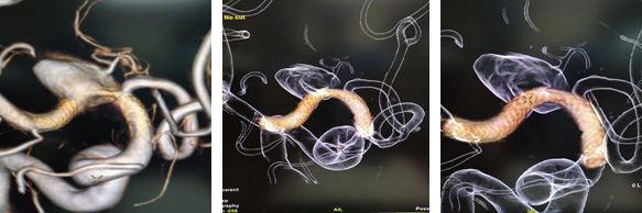 pipeline治动脉瘤,密网支架治疗动脉瘤原理