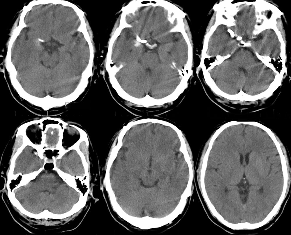 pipeline治动脉瘤,密网支架治疗动脉瘤原理