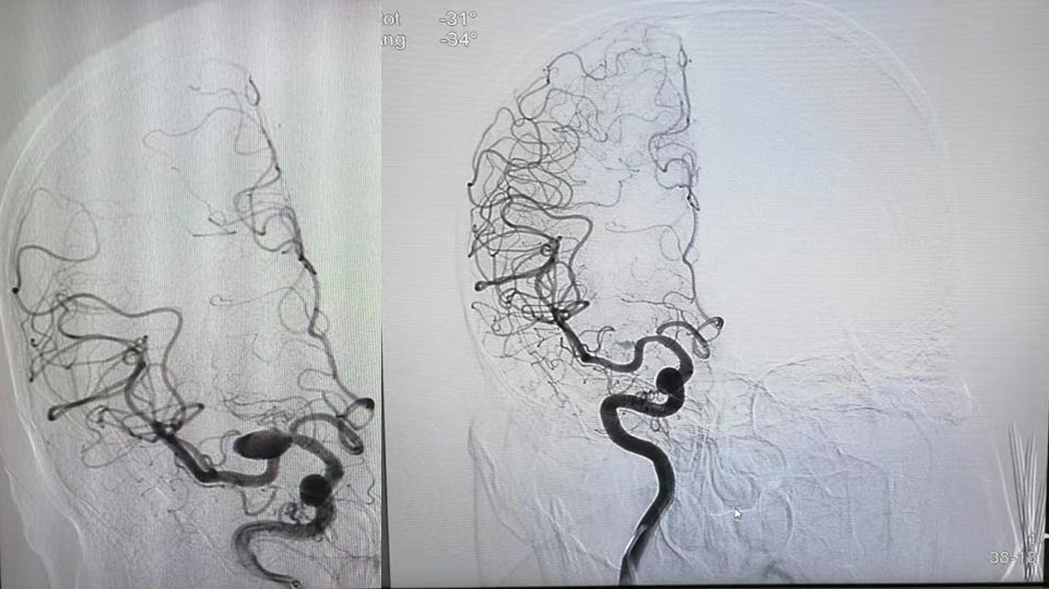 pipeline治动脉瘤,密网支架治疗动脉瘤原理