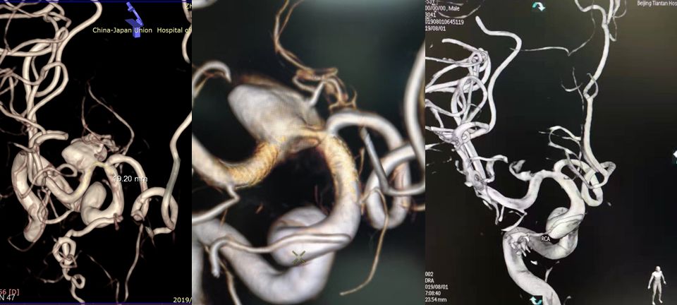 pipeline治动脉瘤,密网支架治疗动脉瘤原理