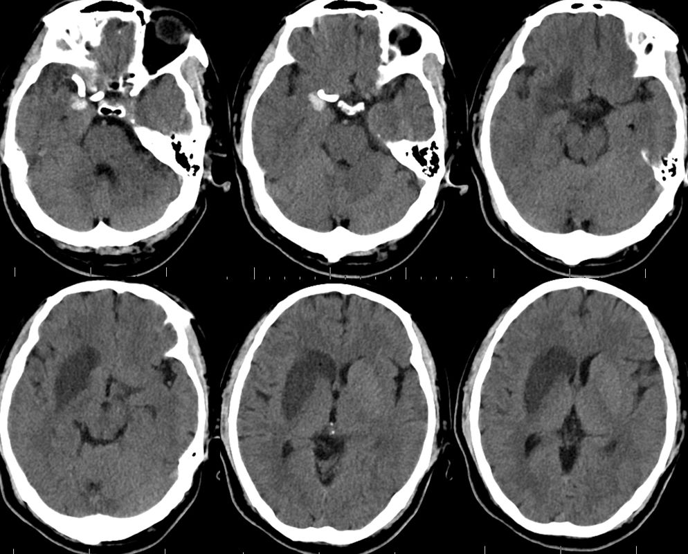 pipeline治动脉瘤,密网支架治疗动脉瘤原理
