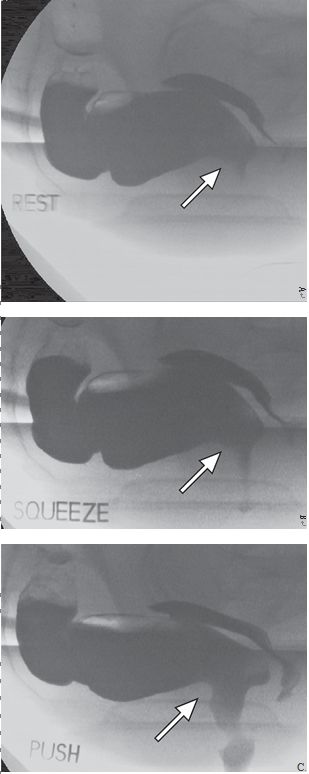 一文读懂：盆底功能障碍的影像学表现|临床实战