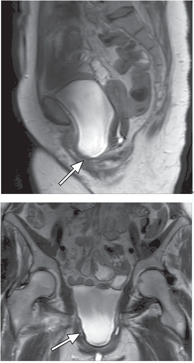一文读懂：盆底功能障碍的影像学表现|临床实战