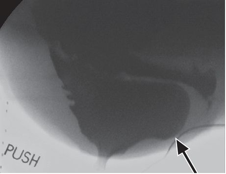 一文读懂：盆底功能障碍的影像学表现|临床实战