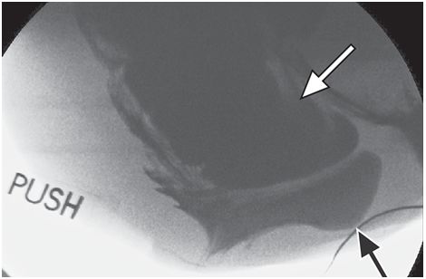 一文读懂：盆底功能障碍的影像学表现|临床实战