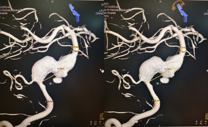 夹层动脉瘤治疗指南,复杂的1型夹层动脉瘤手术