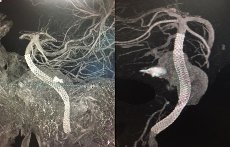 夹层动脉瘤治疗指南,复杂的1型夹层动脉瘤手术