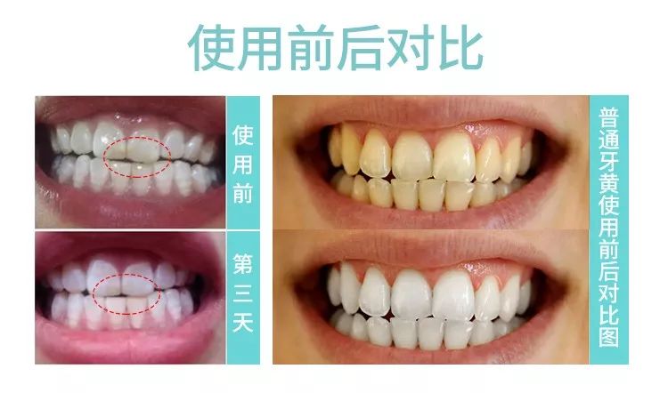 俄罗斯牙膏美白去口臭牙黄,去牙垢黄牙的牙膏测评