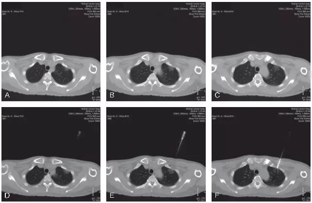 穿刺活检标本包埋切片的注意事项,小结节穿刺活检