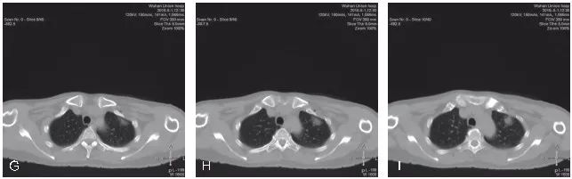 穿刺活检标本包埋切片的注意事项,小结节穿刺活检