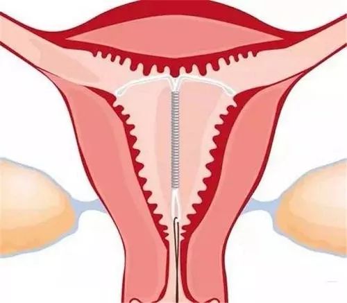 世界避孕日|关于避孕的这些事，你必须知道！