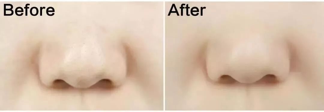 日本草莓鼻去黑头最有效的产品,byebye草莓鼻去黑头神器大揭秘